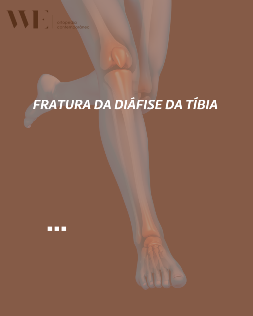 Fratura da Diáfise da Tíbia – We